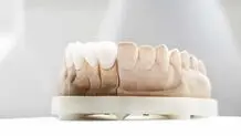 آیا کامپوزیت باعث پوسیدگی دندان میشود؟ 