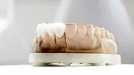آیا کامپوزیت باعث پوسیدگی دندان میشود؟ 
