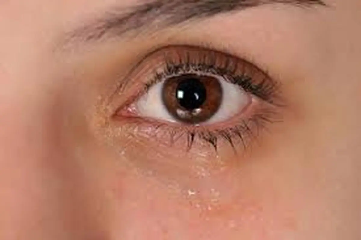 روشی جدید برای درمان خشکی چشم
