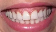 تغییر رنگ لثه به چه علت است؟