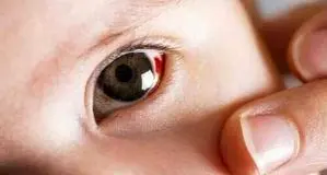 هشدار درباره خونریزی داخل چشمی مبتلایان به دیابت