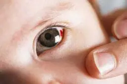 هشدار درباره خونریزی داخل چشمی مبتلایان به دیابت