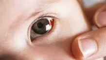 هشدار درباره خونریزی داخل چشمی مبتلایان به دیابت