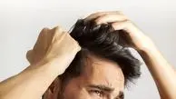 ویتامینی که نبودش پوست سر را به خارش می‌اندازد!

