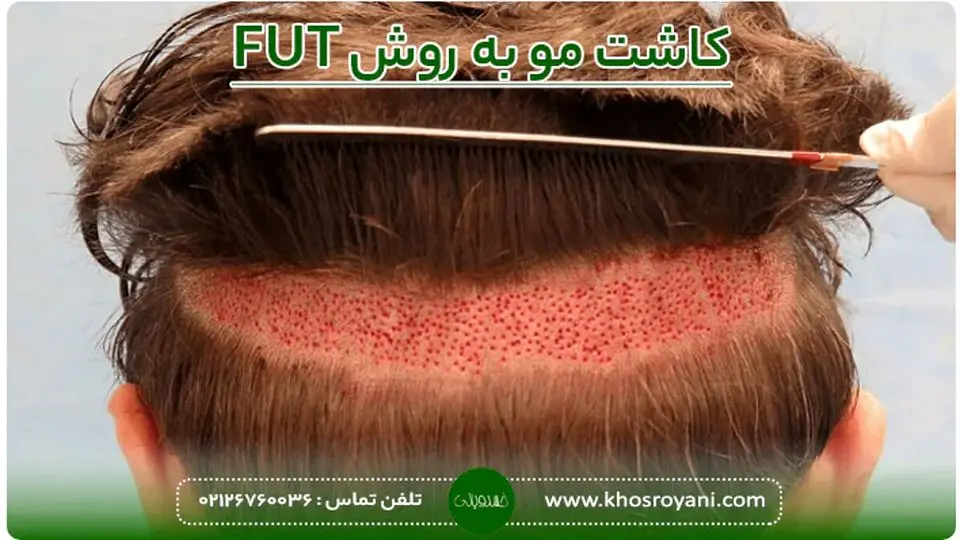 کاشت مو با چه روشی بهتر است