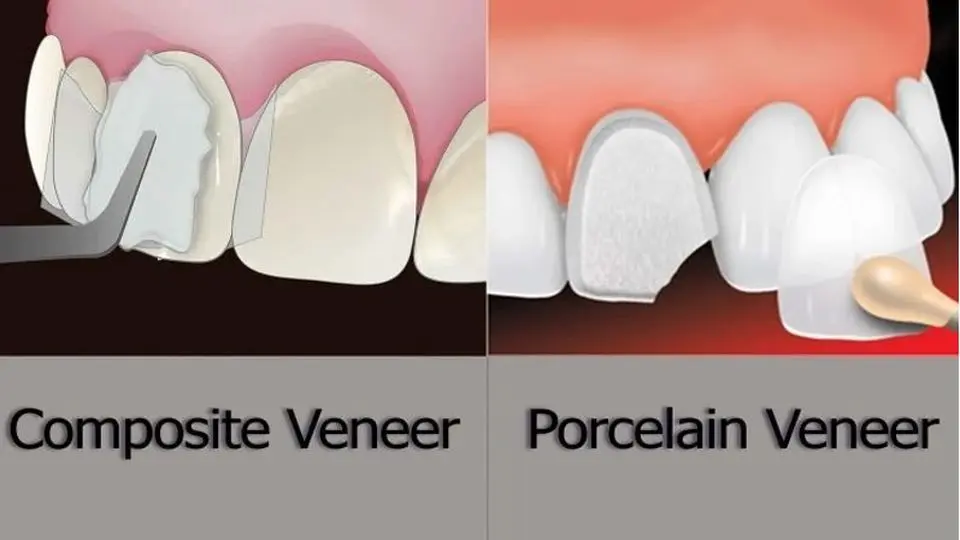 تفاوت لمینت و کامپوزیت دندان چیست؟