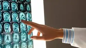 تشخیص ۹ نوع زوال عقل با دقت ۸۸ درصدی توسط هوش مصنوعی