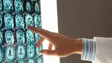 تشخیص ۹ نوع زوال عقل با دقت ۸۸ درصدی توسط هوش مصنوعی