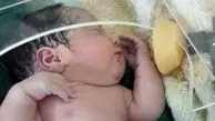 مرگ نوزاد تازه متولدشده با گاز CO۲ در مشهد