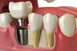 مراقبت بعد از ایمپلنت دندان برای کاهش عوارض و خطرات آن