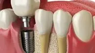مراقبت بعد از ایمپلنت دندان برای کاهش عوارض و خطرات آن