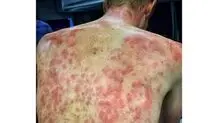 بلایی که تگرگ به سر رکابزنان تور دوفین آورد