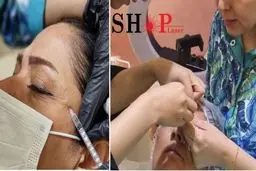 آموزش تزریق فیلر و بوتاکس