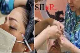 آموزش تزریق فیلر و بوتاکس