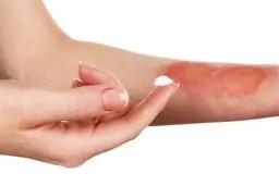  موقع سوختگی چه کنیم؟
