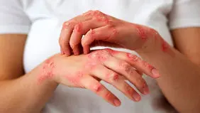 افزایش ابتلا به جذام  در  ایران؟ 
