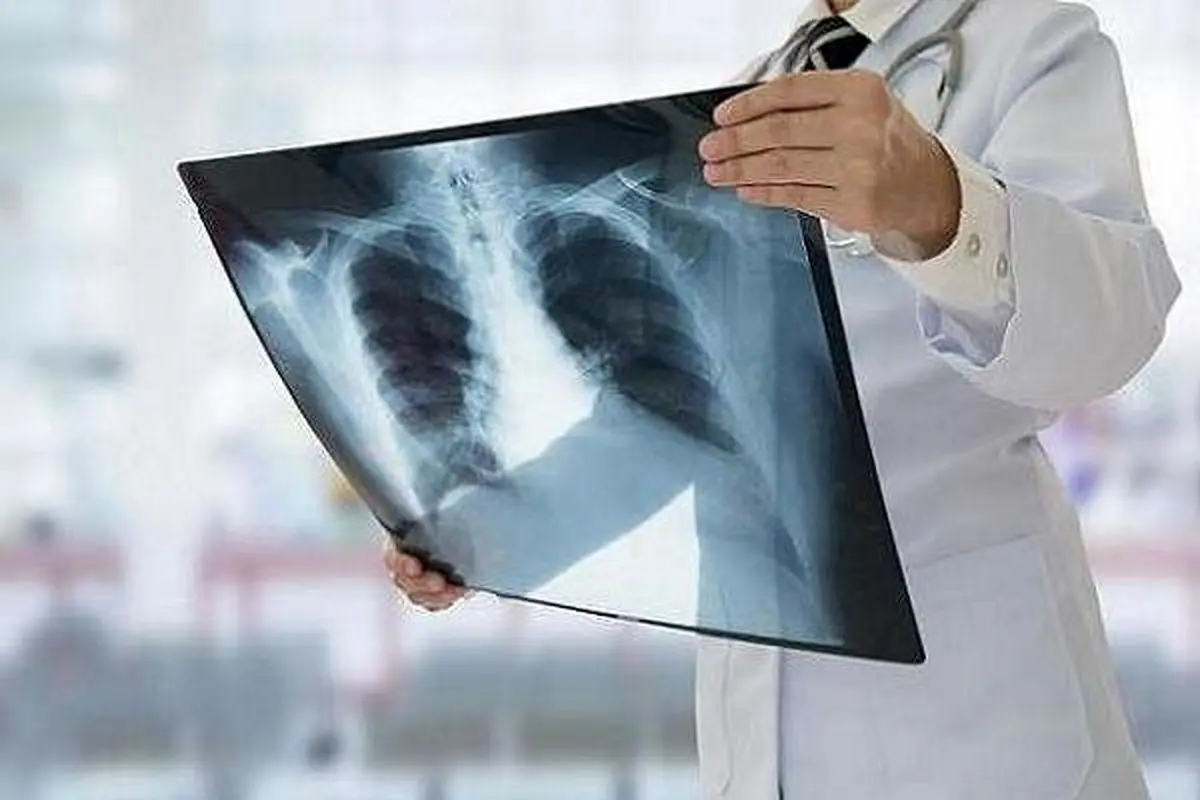 ابتلای بیش از 7‌هزار نفر  به سل در ۱۴۰۲

