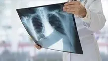 ابتلای بیش از 7‌هزار نفر  به سل در ۱۴۰۲

