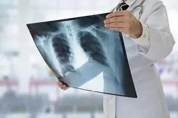 ابتلای بیش از 7‌هزار نفر  به سل در ۱۴۰۲

