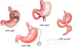 انواع عمل لاغری و مزایا و معایب آنها