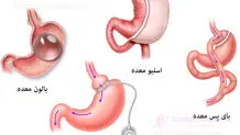 انواع عمل لاغری و مزایا و معایب آنها