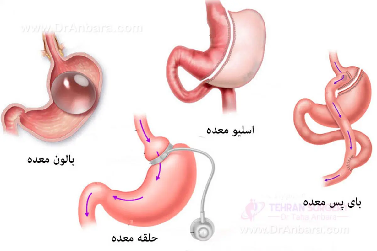 انواع عمل لاغری و مزایا و معایب آنها