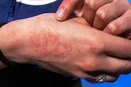 هشدار درباره شیوع این بیماری خطرناک در بهار 