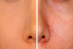 راهنمای کامل کوچک کردن منافذ باز: از ماسک خانگی تا کرم آبرسان تخصصی