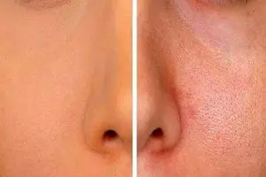 راهنمای کامل کوچک کردن منافذ باز: از ماسک خانگی تا کرم آبرسان تخصصی