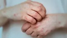 آبله میمونی در وضعیت اضطراری برای بهداشت عمومیِ جهان است