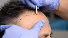 کاشت مو در سن پایین؛ بهترین سن برای اقدام چه زمانی است؟