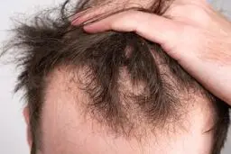 روش‌های موثر درمان ریزش مو مردان | جلوگیری از ریزش مو در آقایان
