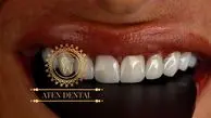 آیا ونیر کامپوزیت دندان باعث حساسیت دندان می‌شود؟