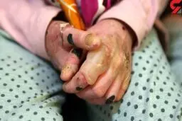 کشف ۱۱ بیمار پوستی عجیب در سربیشه

