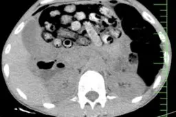 خروج بیش از ۹۰ بسته مواد مخدر از معده و روده یک مرد در کرج

