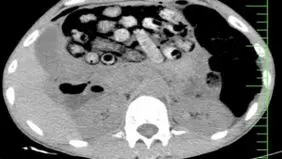 خروج بیش از ۹۰ بسته مواد مخدر از معده و روده یک مرد در کرج

