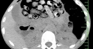 خروج بیش از ۹۰ بسته مواد مخدر از معده و روده یک مرد در کرج

