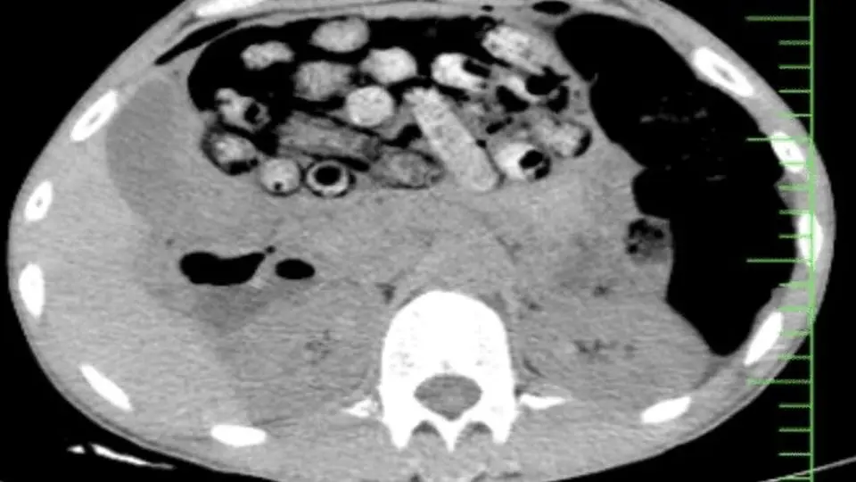 خروج بیش از ۹۰ بسته مواد مخدر از معده و روده یک مرد در کرج

