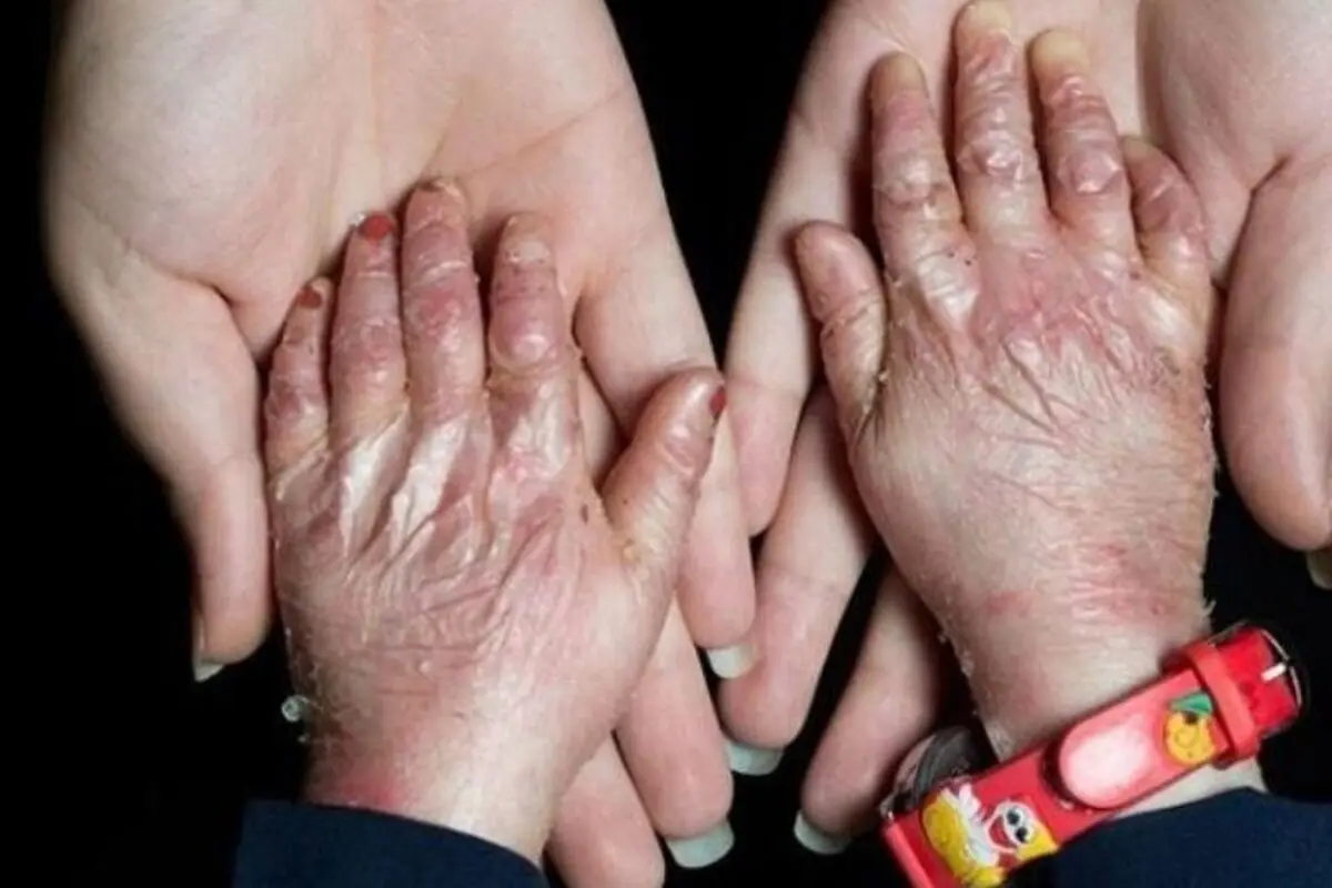 هزینه پانسمان ماهانه تا ۳۰ میلیون تومان