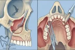 جراحی سینوس لیفت چیست؟ مراحل و مزایا