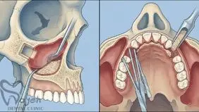 جراحی سینوس لیفت چیست؟ مراحل و مزایا