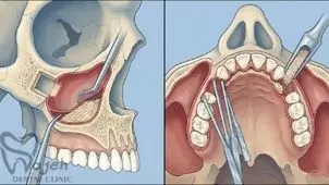 جراحی سینوس لیفت چیست؟ مراحل و مزایا