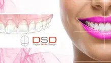 لمینت دندان چیست و چگونه انجام می‌شود؟