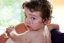 «تب گوجه فرنگی» چه علائمی دارد؟