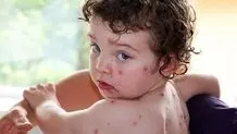 «تب گوجه فرنگی» چه علائمی دارد؟