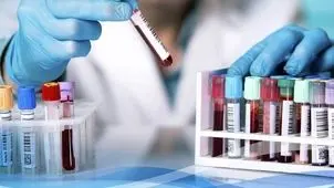 ماجرای حذف آزمایش ویتامین D از فهرست بیمه چیست؟
