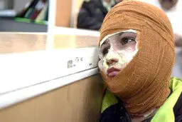 رنج بسیار بیماران سوخته
