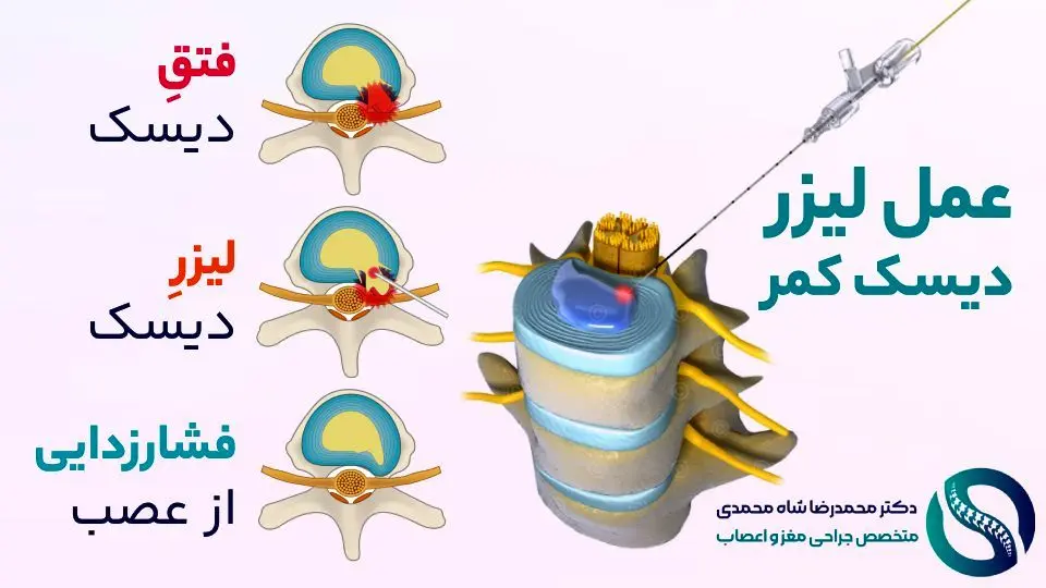 دکتر محمدرضا شاه محمدی متخصص عمل جراحی دیسک کمر با لیزر در تهران