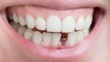تعرفه خدمات دندانپزشکی در تهران چقدر است؟