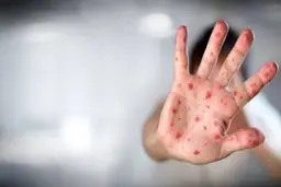 "آبله میمونی" وضعیت اضطراری بهداشت جهانی اعلام شد